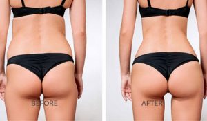 before and after sculptra butt lift treatment