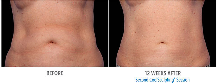 Before and after CoolSculpting fat treatment for stomach.