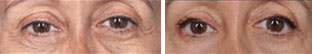 Before and after thermi250 thermismooth body skin tightening for eyelids