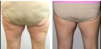 Before and after thermi250 thermismooth body skin tightening for cellulite reduction