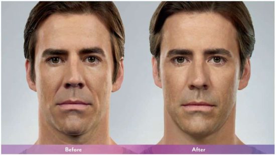 Chin Fillers Before and After