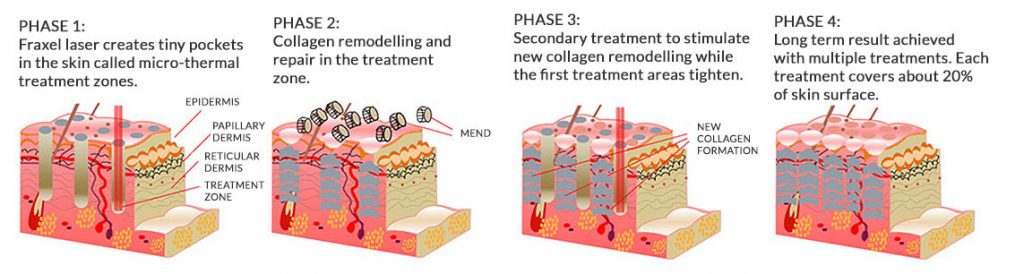 How-Fraxel-Skin-Resurfacing-works