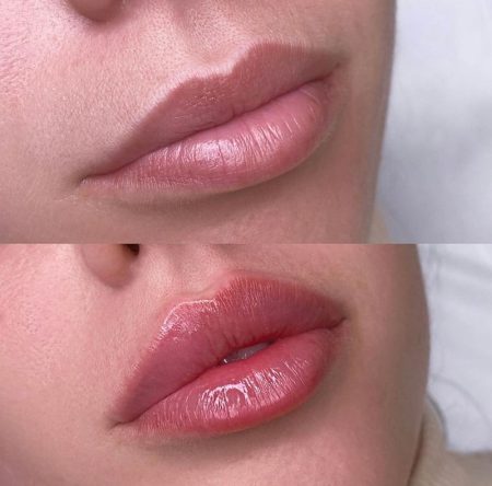 Lip Fillers 9 Before and After