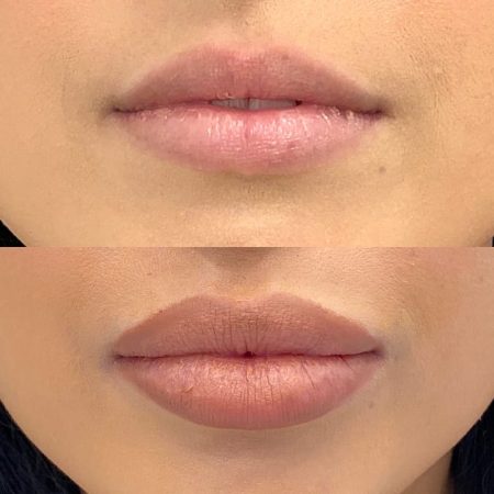 Lip Fillers BA 3