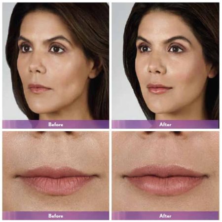 Lip Injections Before and After