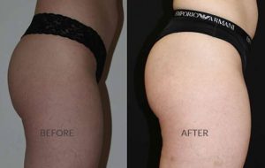 before and after sculptra butt lift treatment