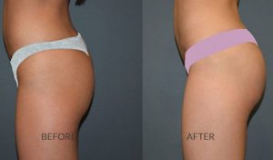 before and after sculptra butt lift treatment