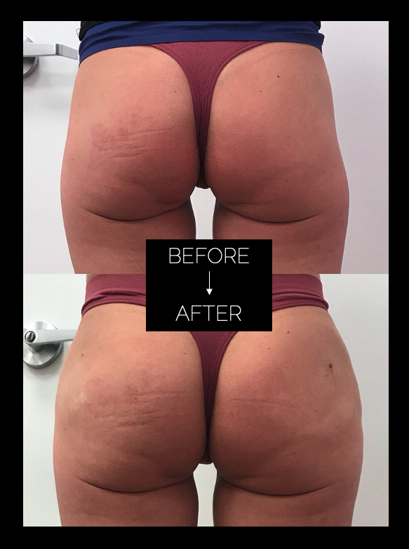 Before and After Sculptra Butt Lift