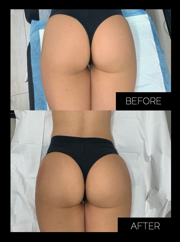 Sculptra Butt Lift Before and After Photo