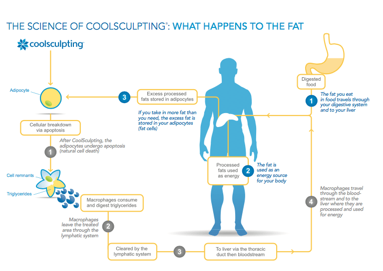 CoolSculpting diagram