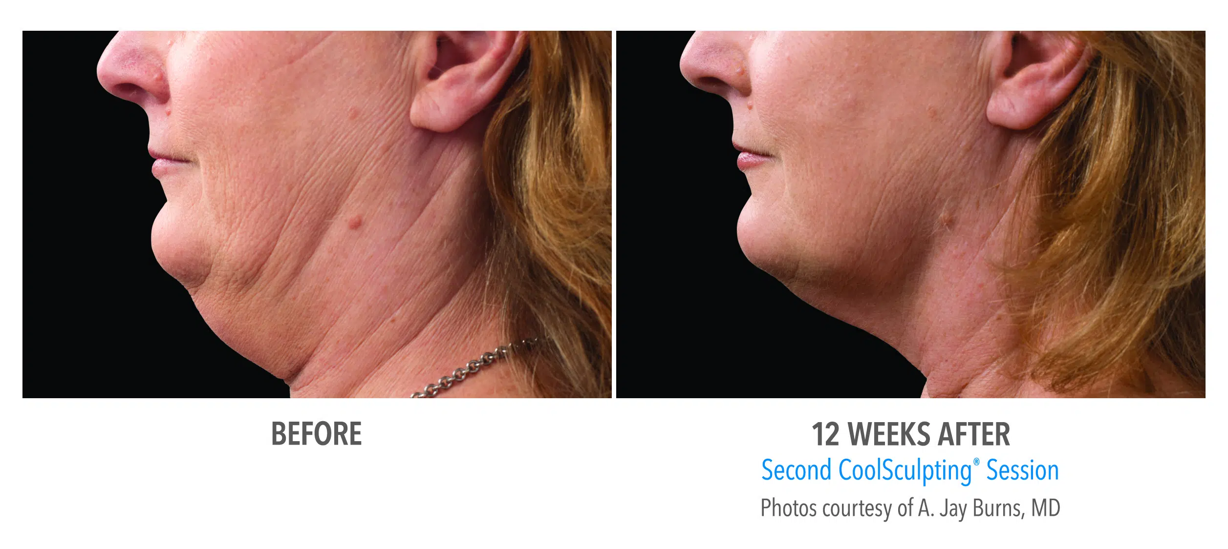 CoolSculpting Chin Before and After