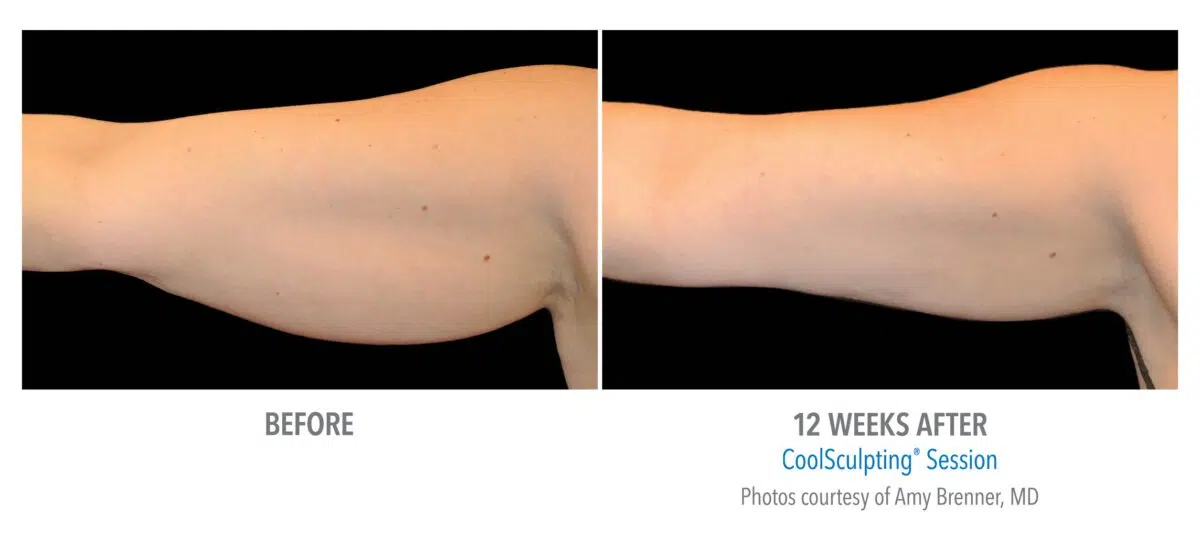 CoolSculpting Arms Before and After