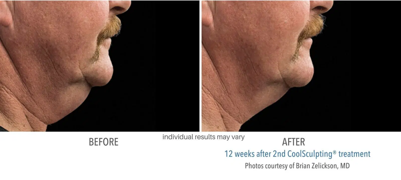 Before and After CoolSculpting Chin