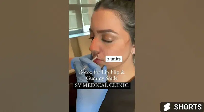 Botox Lip Flip