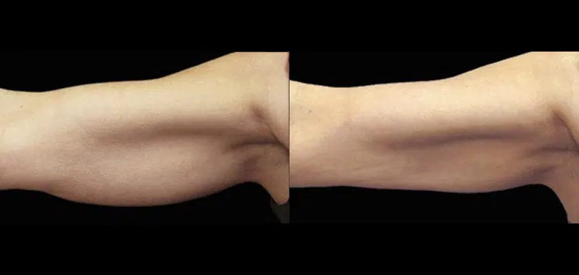 coolsculpting arms before and after