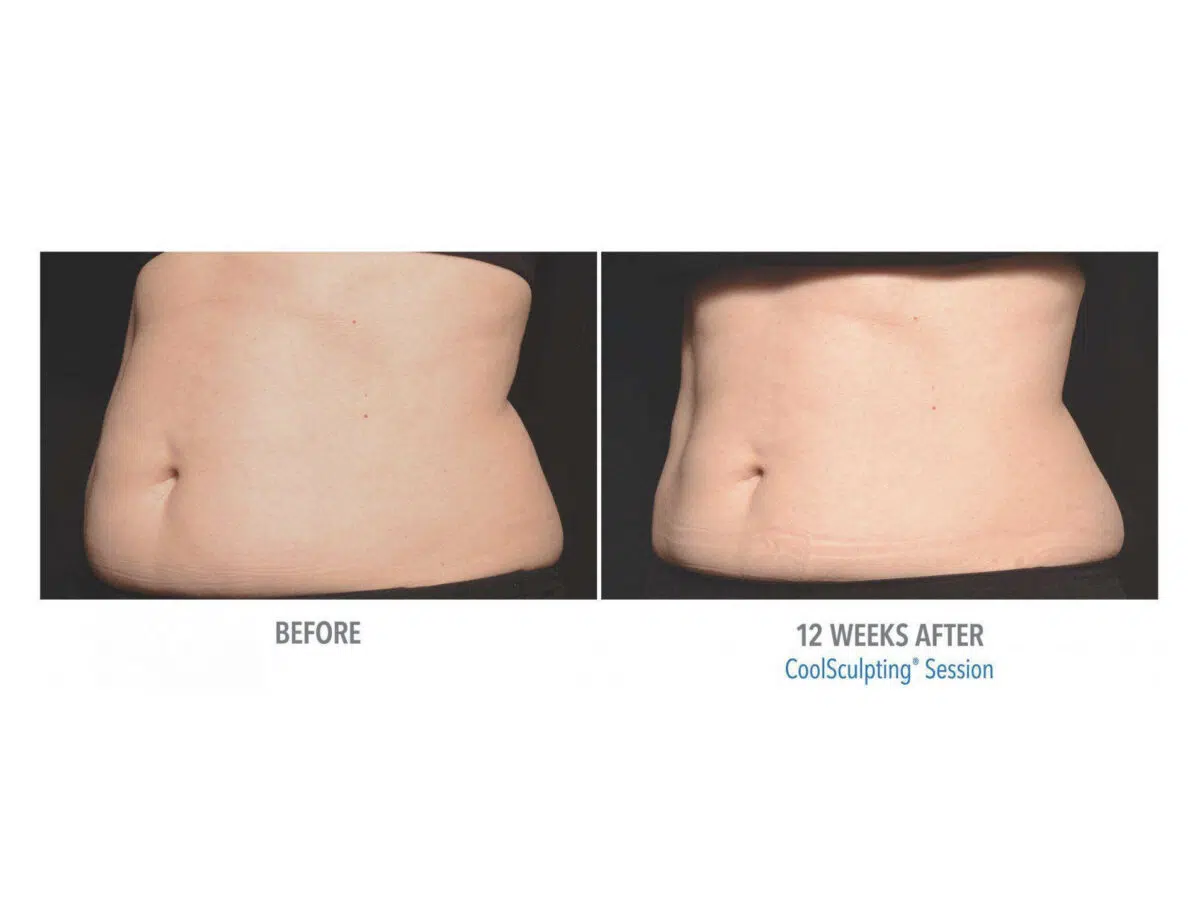 CoolSculpting Stomach Before and After