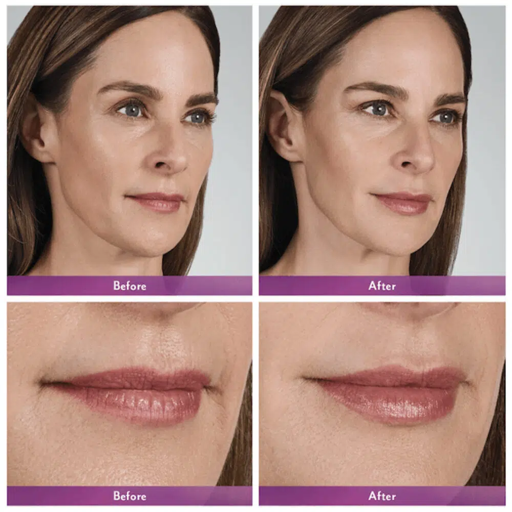 Dermal Fillers