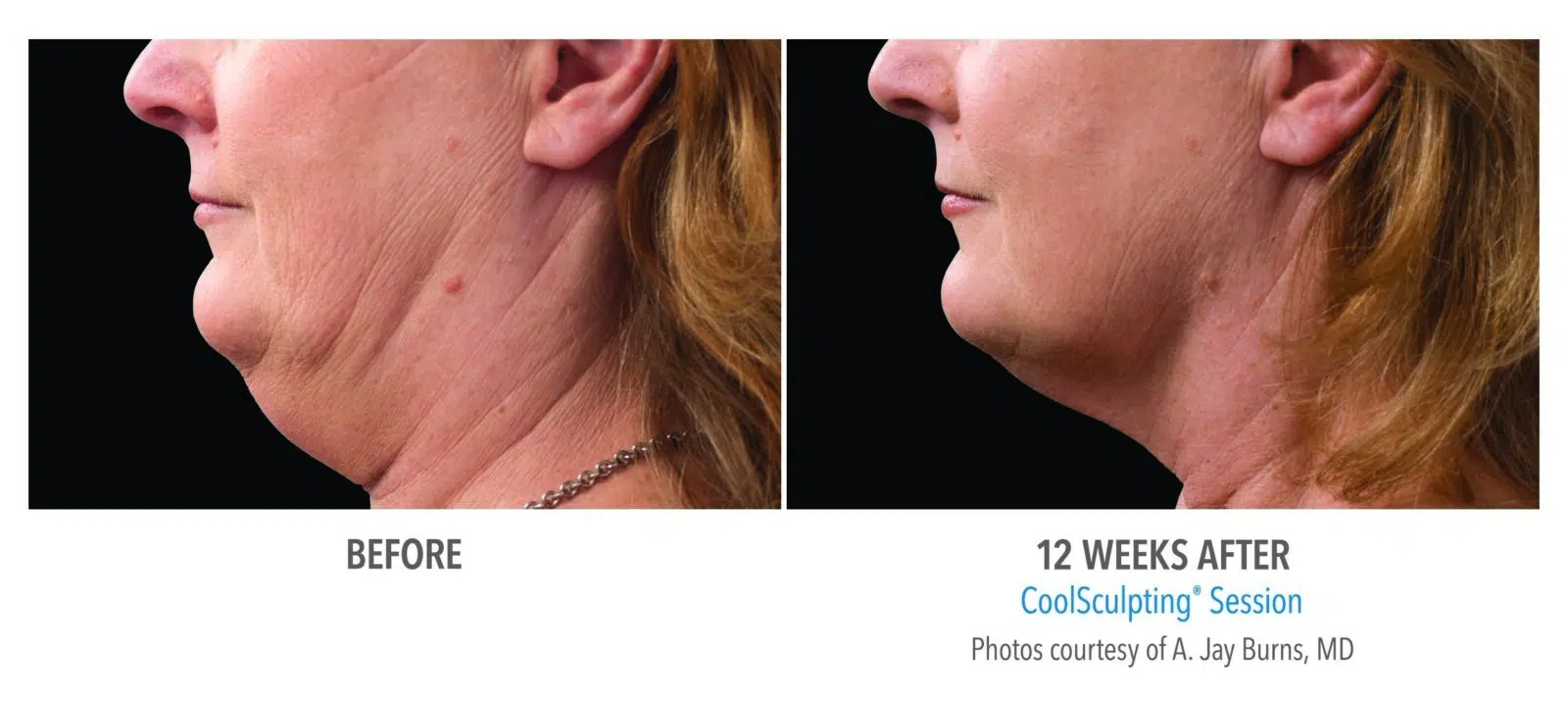 cool sculpting chin before and after