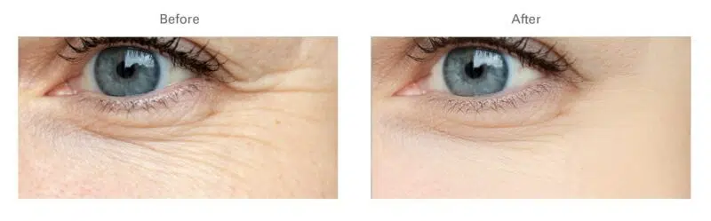 Botox for Botox Under Eye