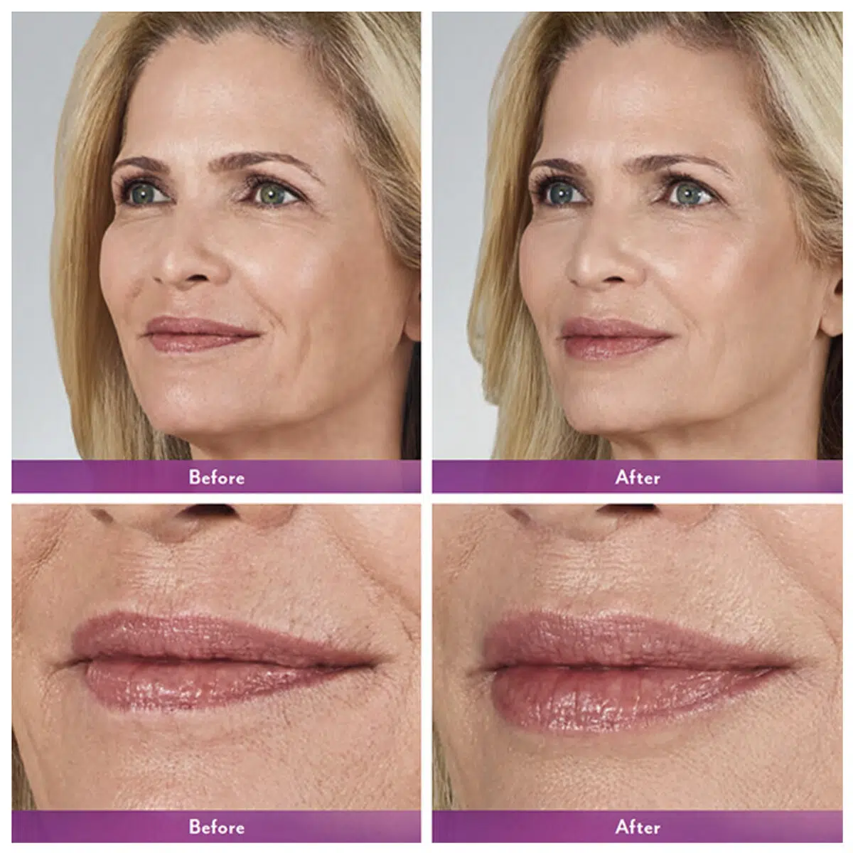 Lip Augmentation Before and After