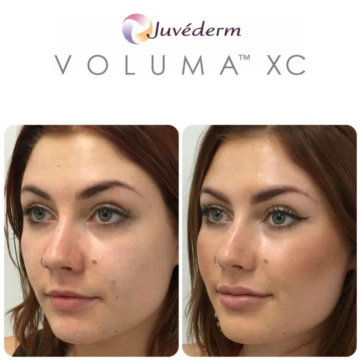 Voluma Cheek Filler